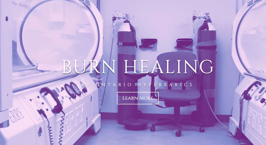 Burn Healing At Ontario